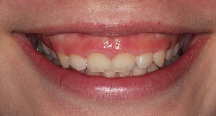 Laser Gum Contouring - Thornhill, Vaughan, Richmond Hill Dentist